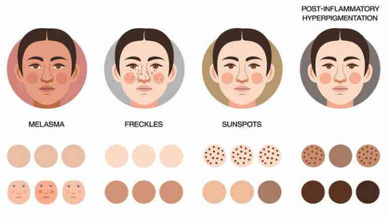 What Are the Different Types of Face Pigmentation?
