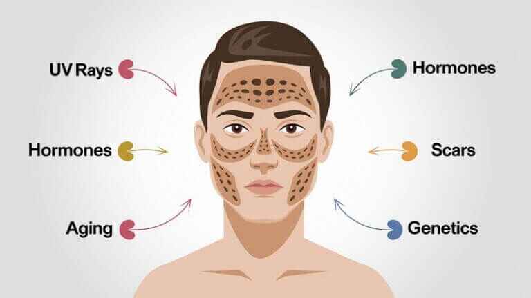 What Are the Causes of Facial Pigmentation?