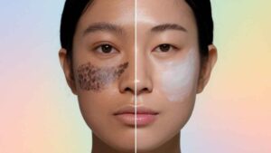 How to Reduce Melanin in Skin Naturally and Permanently