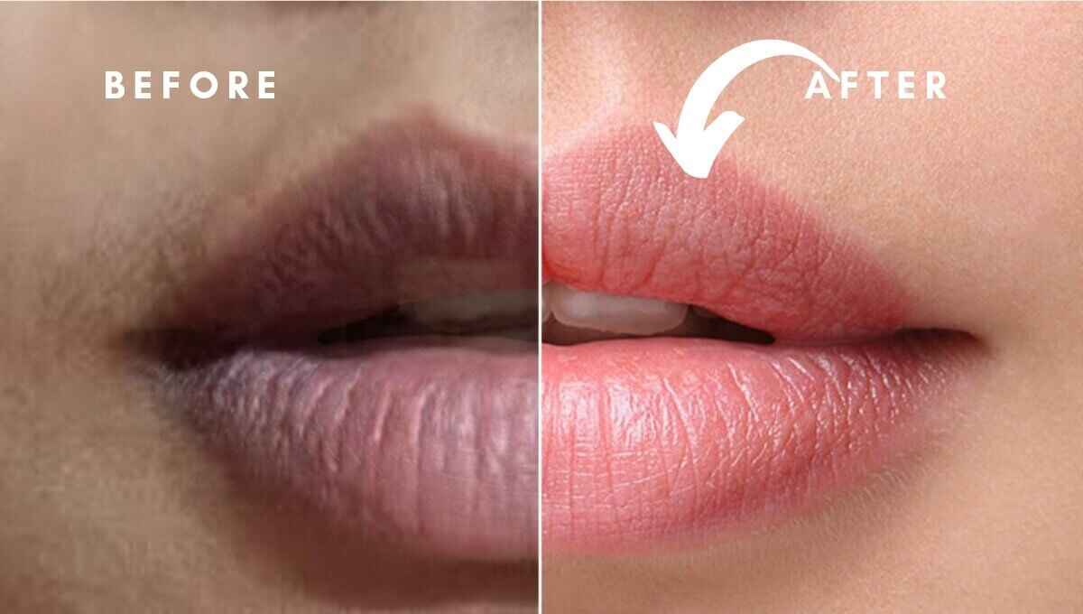 How to Get Dark Lips to Pink Lips Naturally at Home - Dreemato