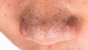 Natural ways to remove blackheads from nose permanently at home using simple remedies and best products for clean skin in 2025.