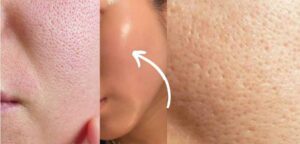 Woman applying natural remedy to shrink large pores on face using clay mask and aloe vera, effective 2025 pore-tightening tips