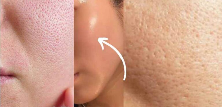 Woman applying natural remedy to shrink large pores on face using clay mask and aloe vera, effective 2025 pore-tightening tips