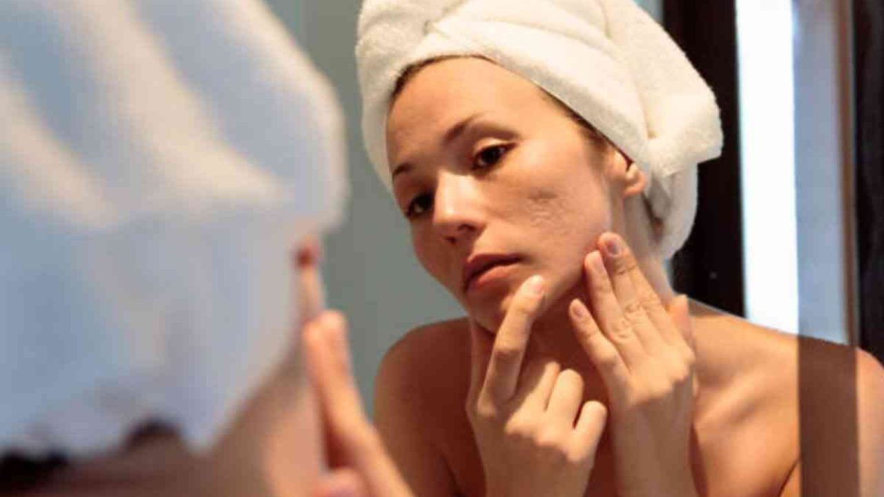 Girl applying aloe vera to remove pimple marks naturally at home fast, simple skincare routine for clear glowing skin in 2025