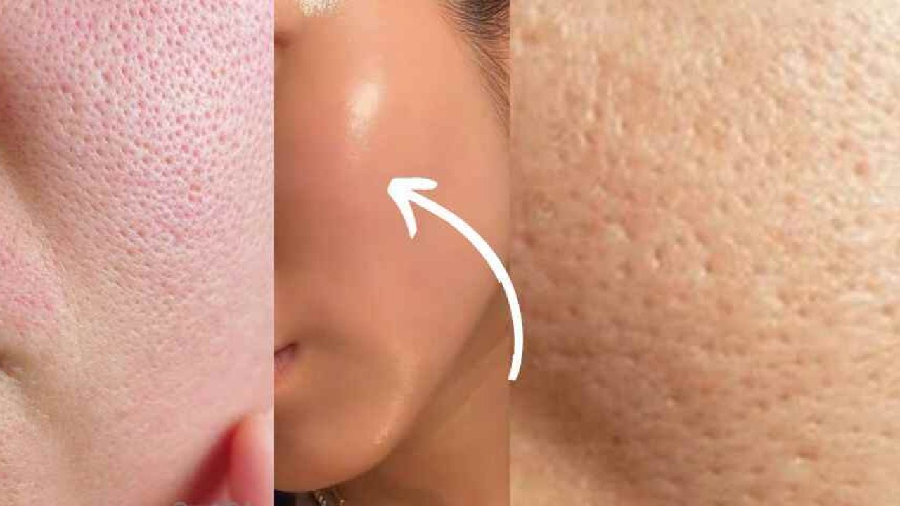 Woman applying natural remedy to shrink large pores on face using clay mask and aloe vera, effective 2025 pore-tightening tips
